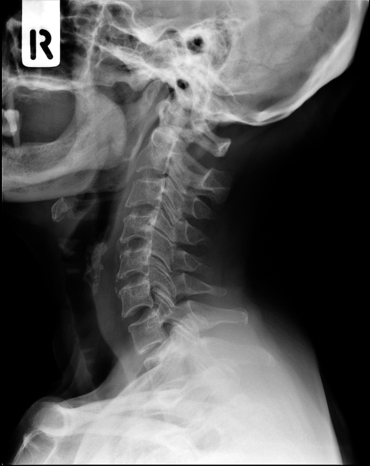 neck xray