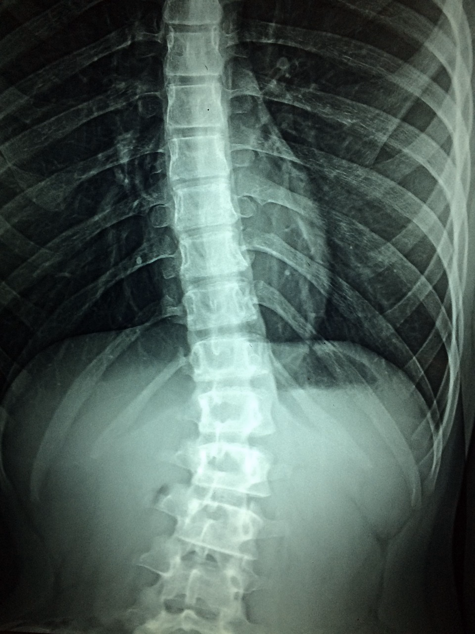 spine